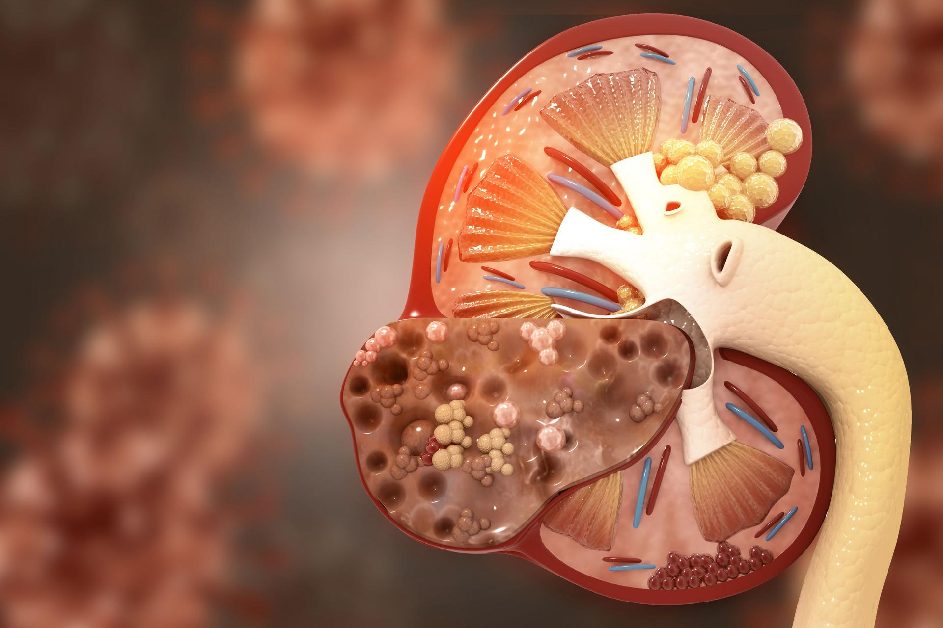 Diseased human kidney, kidney cancer. 3d illustration