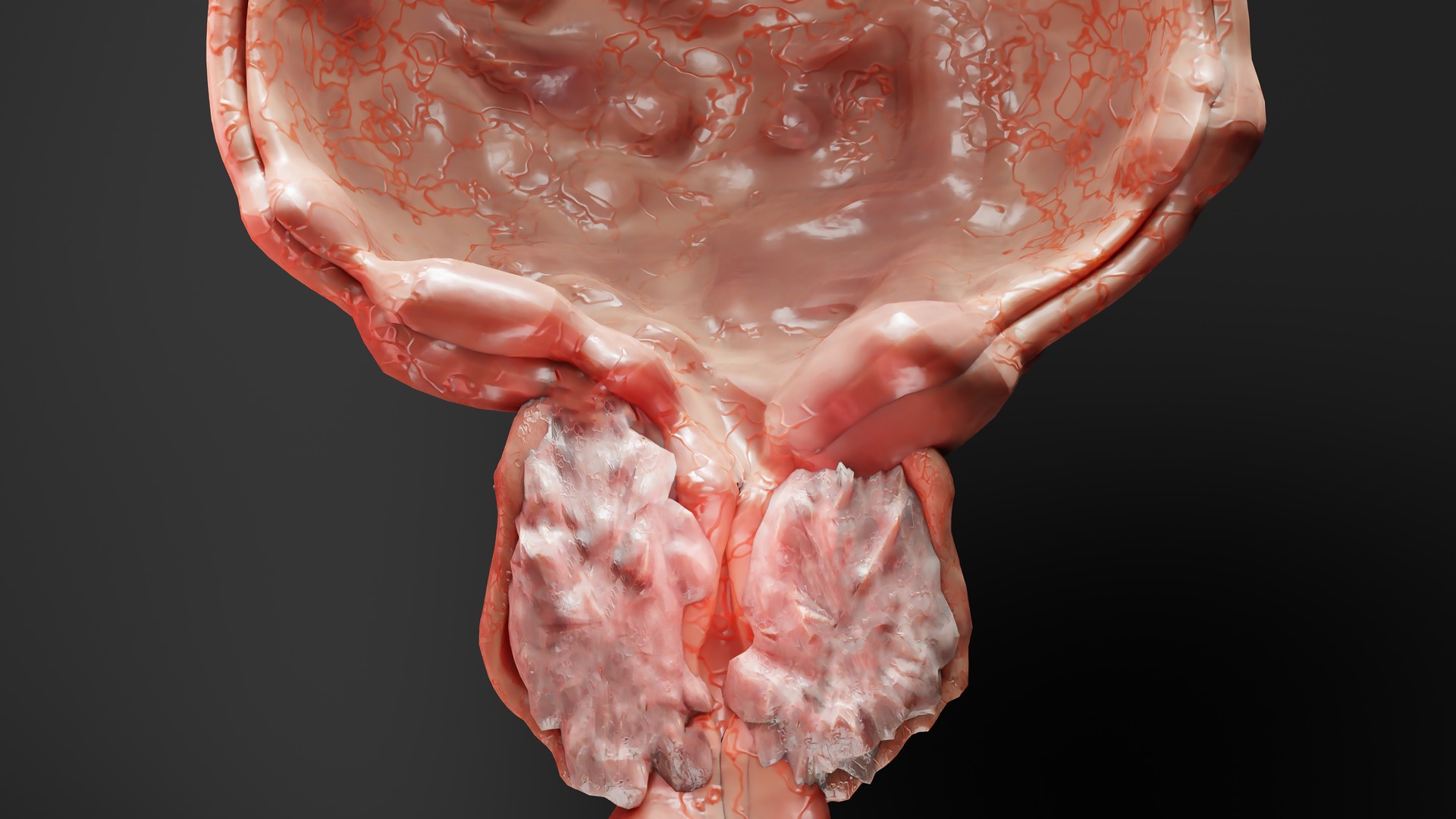 Benign prostatic, Enlargement and inflammation of the prostate, hypertrophy, hyperplasia (BPH), male reproductive system, bladder anatomy, urology, enlarged prostate gland, Prostatitis, 3d render